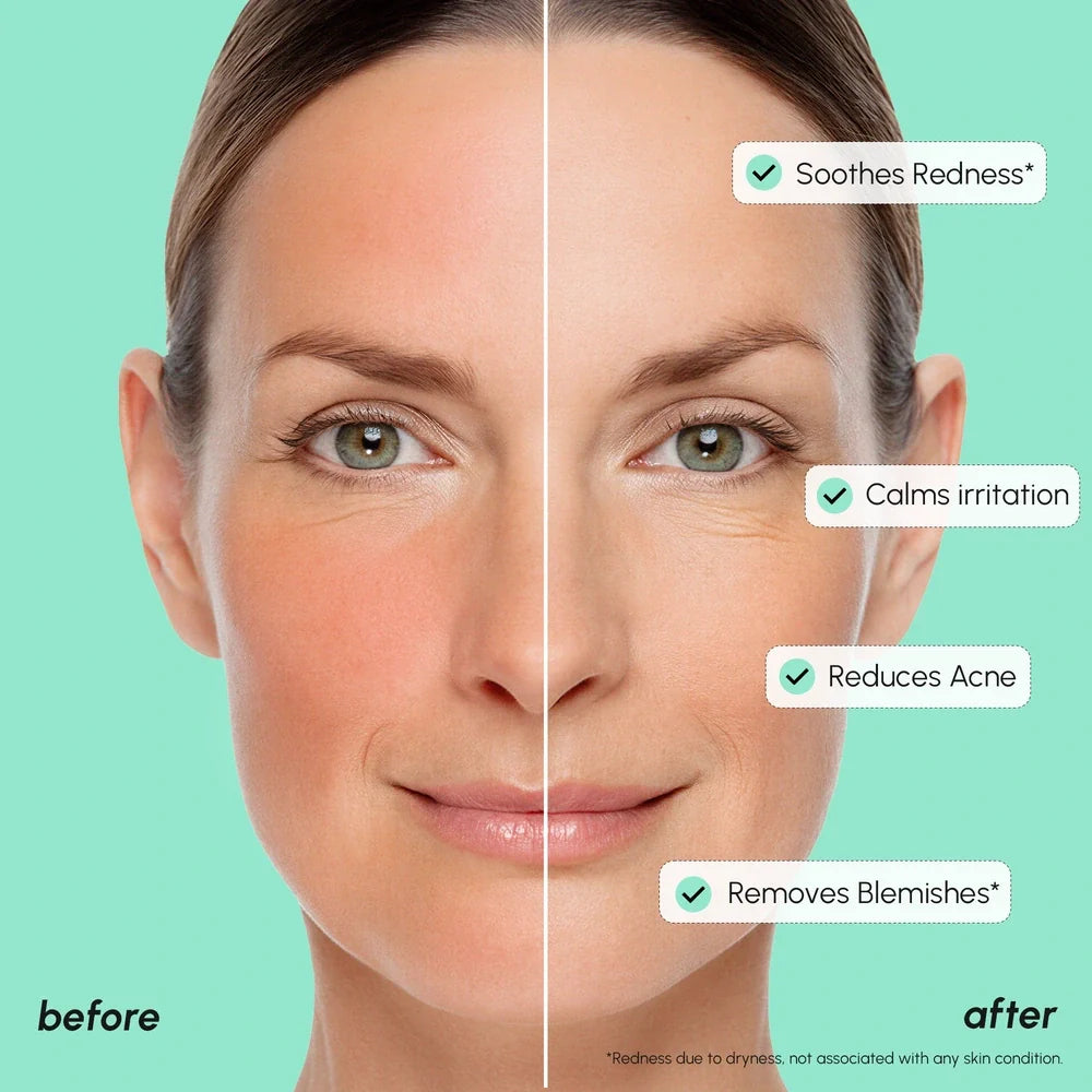 Redness Soothing Azelaic Acid Serum