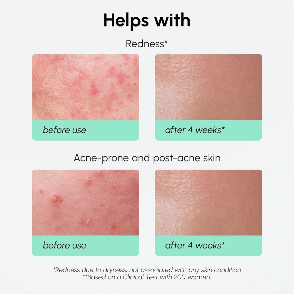 Redness Soothing Azelaic Acid Serum